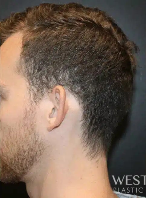 Before Image: Otoplasty - left-side