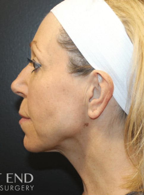 After Image: Renuvion (J-Plasma) Tightening - left-side