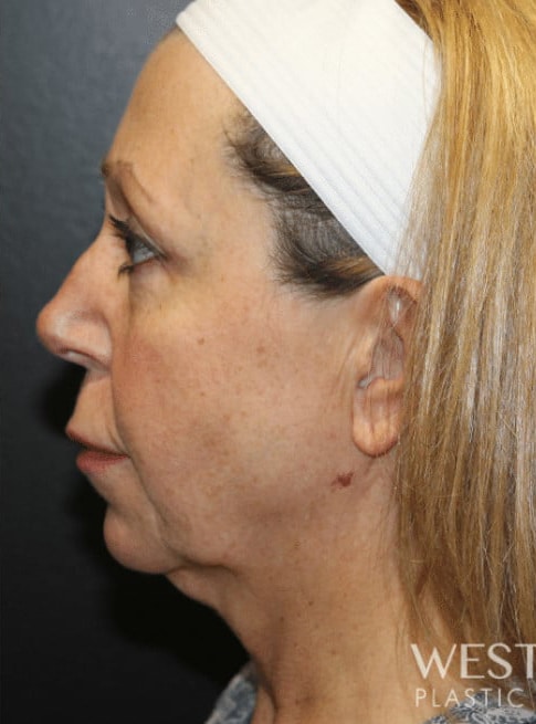 Before Image: Renuvion (J-Plasma) Tightening - left-side