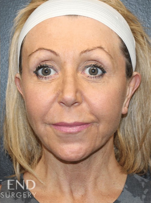 After Image: Renuvion (J-Plasma) Tightening - front