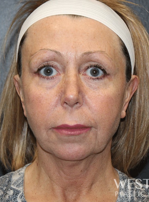 Before Image: Renuvion (J-Plasma) Tightening - front