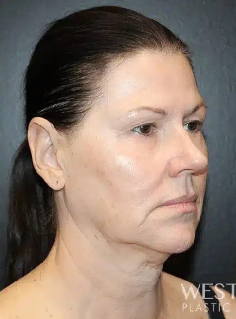 Before Image: Facelift, Blepharoplasty, Fat Grafting, & CO2 Resurfacing - right-front-oblique