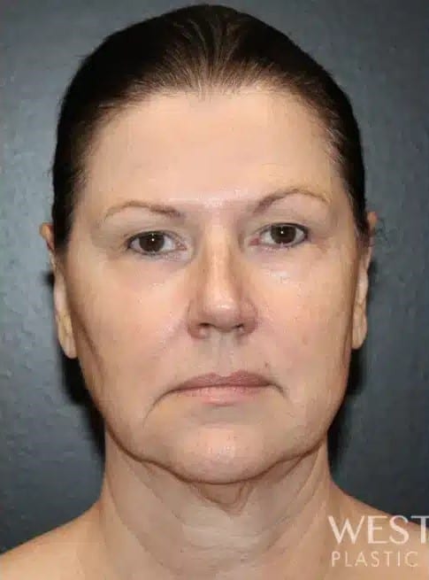 Before Image: Facelift, Blepharoplasty, Fat Grafting, & CO2 Resurfacing - front