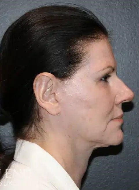 After Image: Facelift, Blepharoplasty, Fat Grafting, & CO2 Resurfacing - right-side