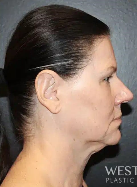 Before Image: Facelift, Blepharoplasty, Fat Grafting, & CO2 Resurfacing - right-side