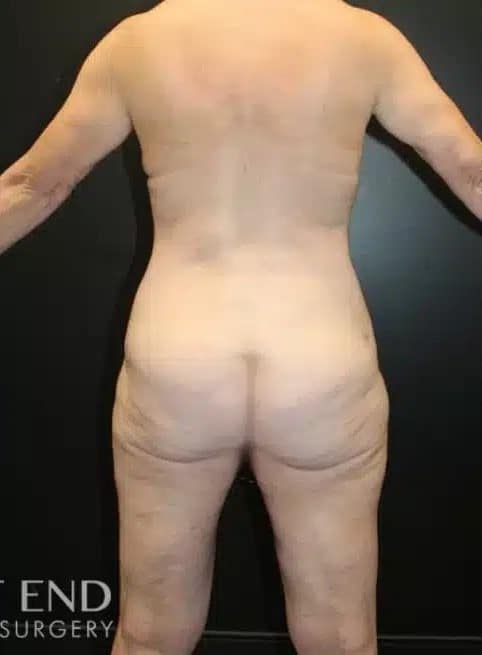 After Image: Liposuction and Renuvion Skin Tightening - back