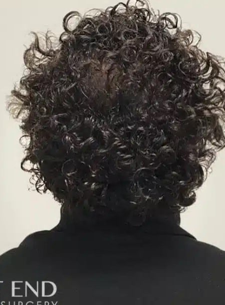 After Image: Non-Surgical Hair Restoration with PRP - back