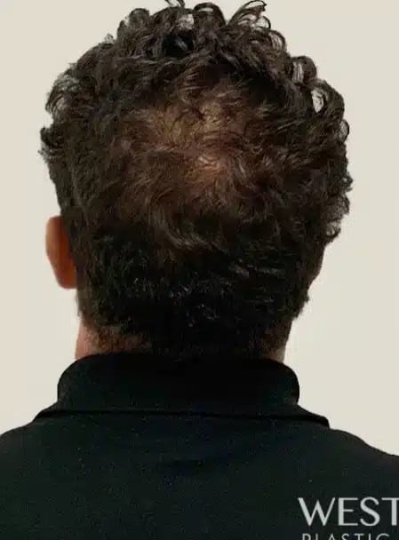 Before Image: Non-Surgical Hair Restoration with PRP - back