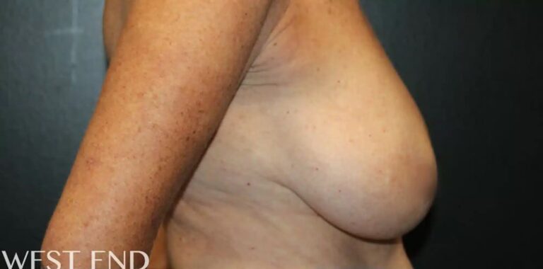 Before Image: Breast Reduction - right-side