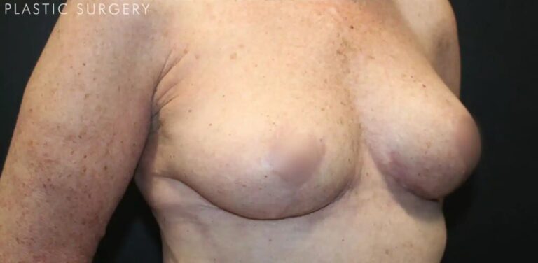 After Image: Breast Reduction - right-front-oblique