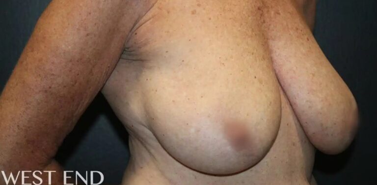 Before Image: Breast Reduction - right-front-oblique