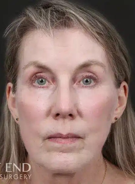 After Image: Renuvion (J-Plasma) Tightening & Resurfacing - front