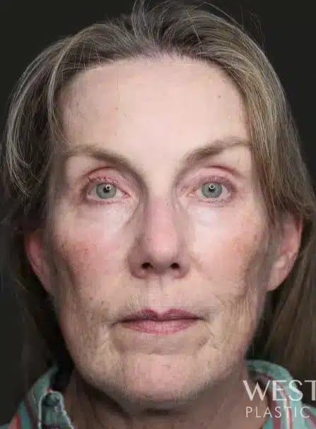 Before Image: Renuvion (J-Plasma) Tightening & Resurfacing - front
