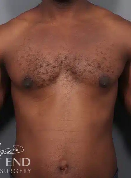 After Image: Gynecomastia (using Liposuction & Renuvion) - front