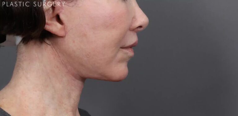 After Image: Facelift, Neck Lift & Upper Lip Lift - right-side