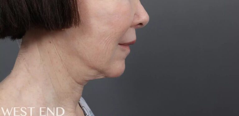 Before Image: Facelift, Neck Lift & Upper Lip Lift - right-side