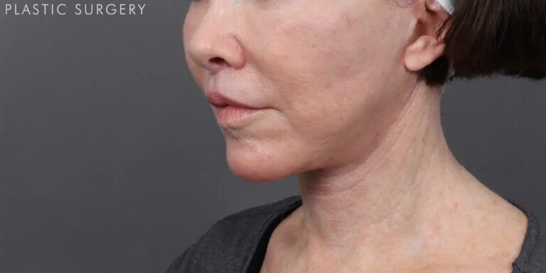 After Image: Facelift, Neck Lift & Upper Lip Lift - left-front-oblique