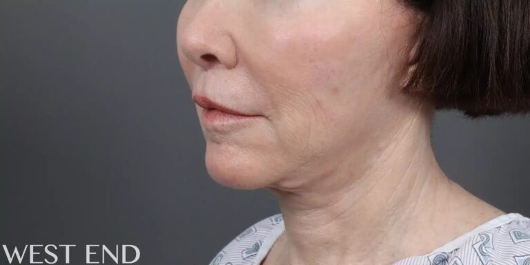 Before Image: Facelift, Neck Lift & Upper Lip Lift - left-front-oblique