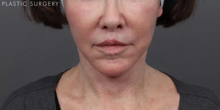 After Image: Facelift, Neck Lift & Upper Lip Lift - front