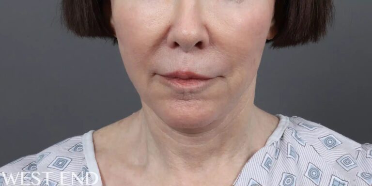Before Image: Facelift, Neck Lift & Upper Lip Lift - front
