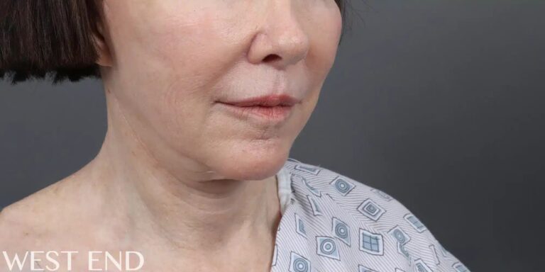 Before Image: Facelift, Neck Lift & Upper Lip Lift - right-front-oblique