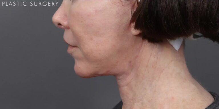 After Image: Facelift, Neck Lift & Upper Lip Lift - left-side