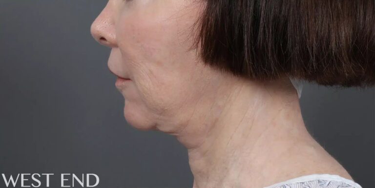 Before Image: Facelift, Neck Lift & Upper Lip Lift - left-side