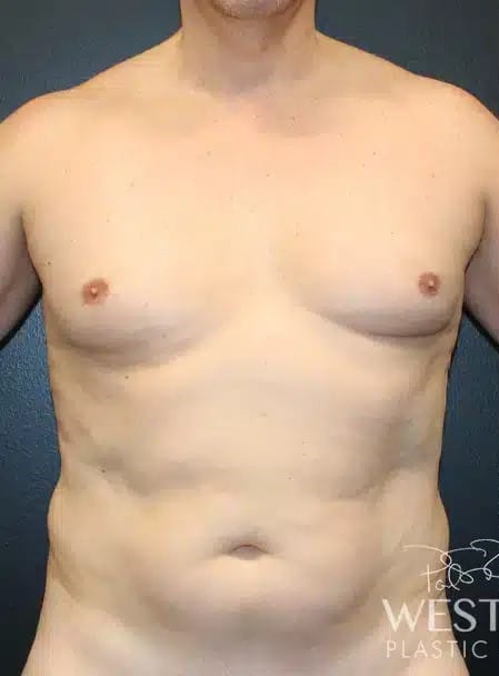 Before Image: Liposuction and Renuvion Skin Tightening - front