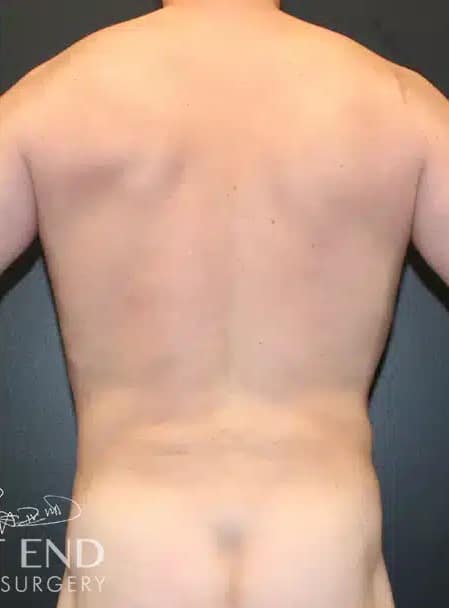 After Image: Liposuction and Renuvion Skin Tightening - back