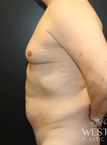 Before Image: Liposuction and Renuvion Skin Tightening - left-side