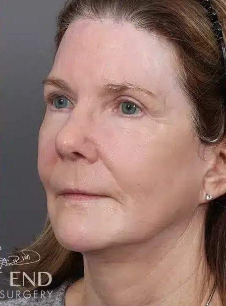 After Image: Renuvion (J-Plasma) Resurfacing & Fat Grafting - left-front-oblique