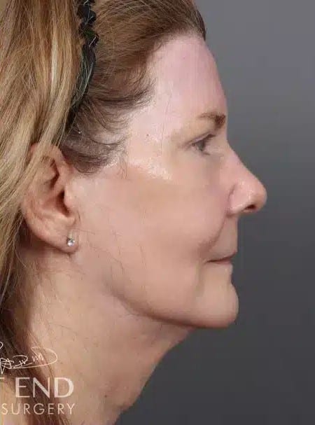 After Image: Renuvion (J-Plasma) Resurfacing & Fat Grafting - right-side
