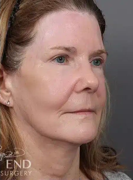 After Image: Renuvion (J-Plasma) Resurfacing & Fat Grafting - right-front-oblique