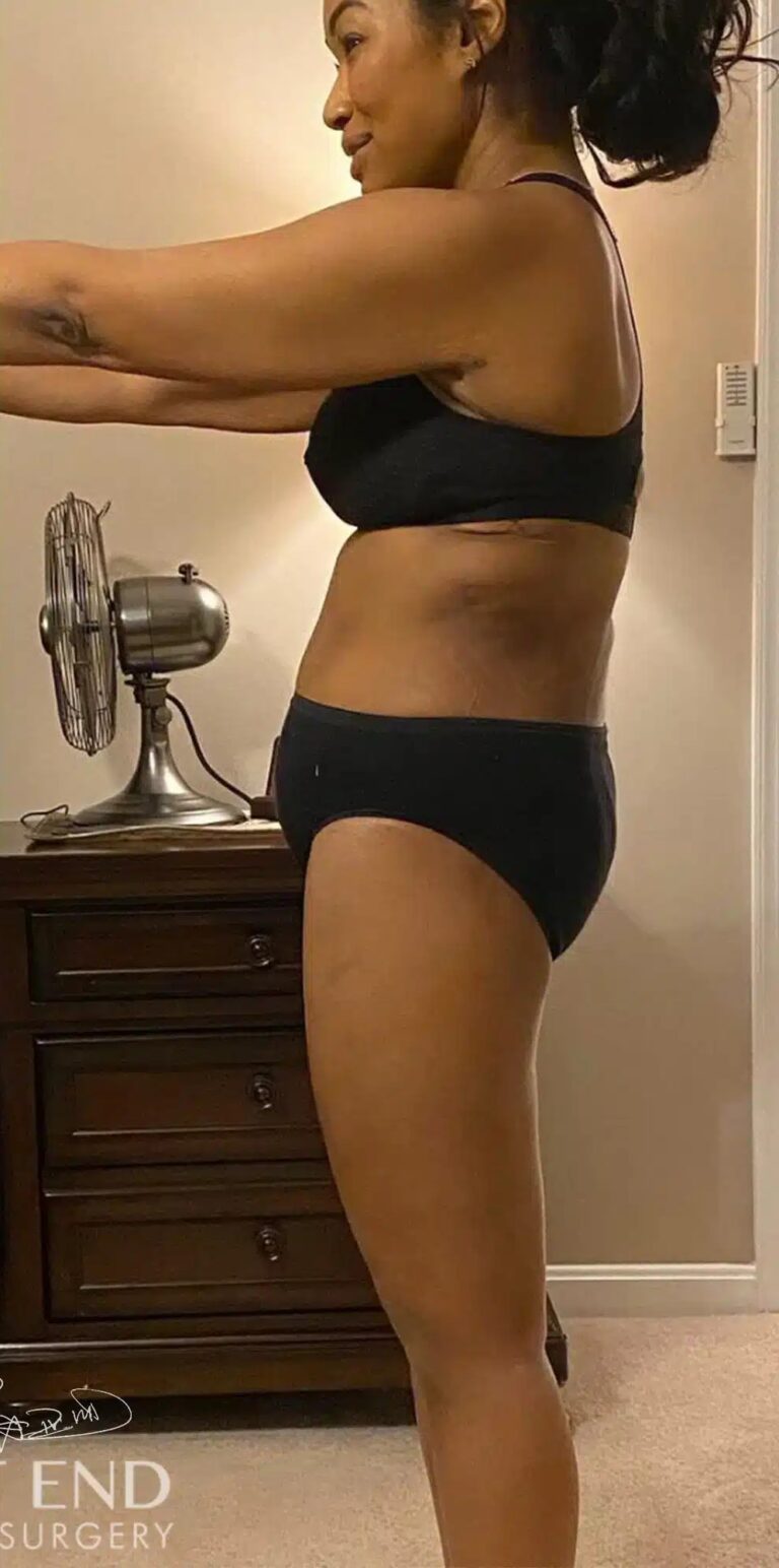 After Image: Post Weight Loss: Lower Body Lift, Liposuction & Renuvion Skin Tightening - left-side