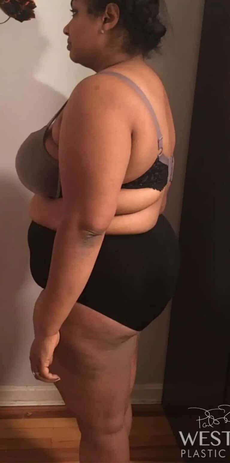 Before Image: Post Weight Loss: Lower Body Lift, Liposuction & Renuvion Skin Tightening - left-side