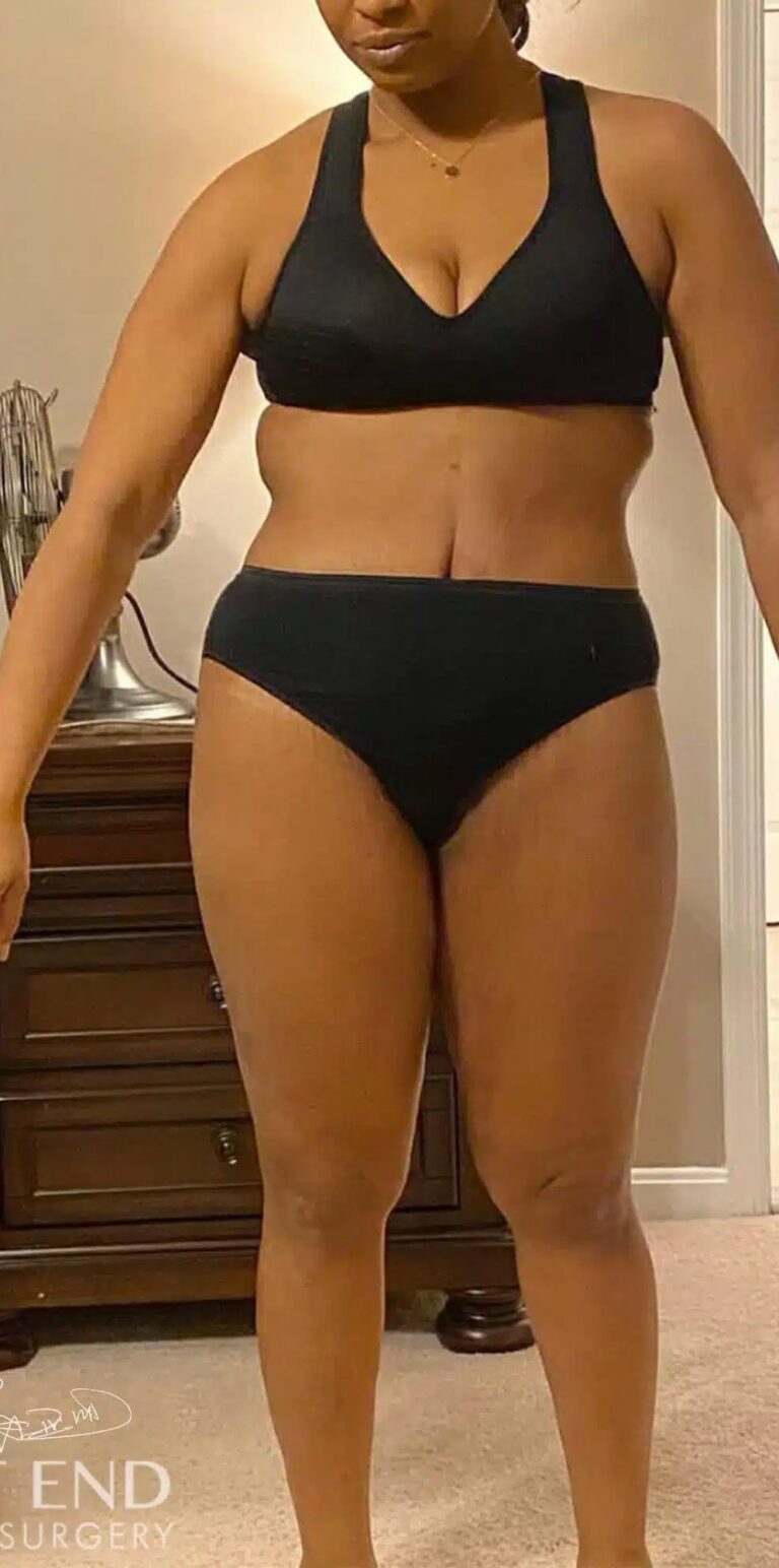 After Image: Post Weight Loss: Lower Body Lift, Liposuction & Renuvion Skin Tightening - front