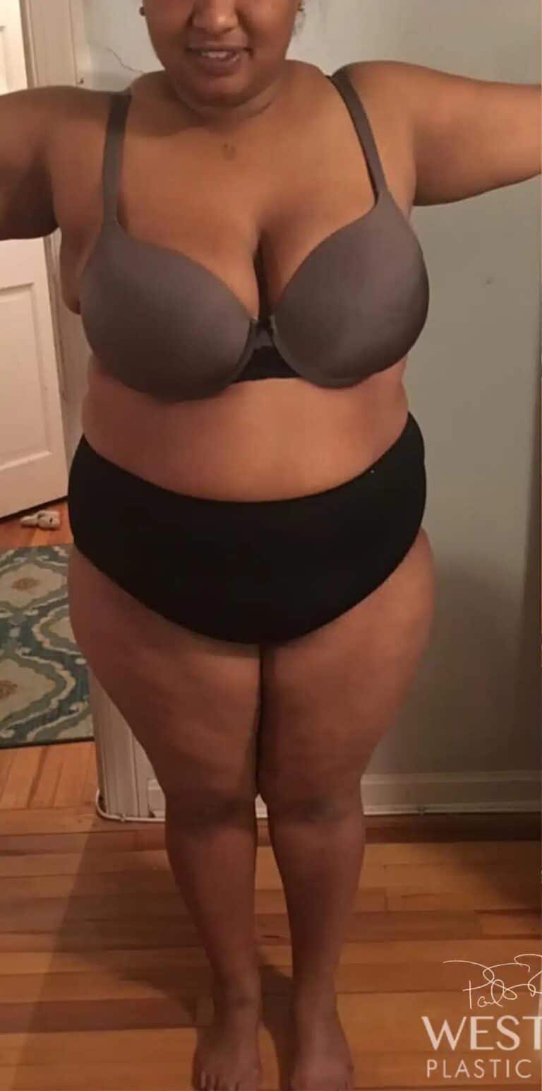 Before Image: Post Weight Loss: Lower Body Lift, Liposuction & Renuvion Skin Tightening - front