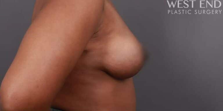 After Image: Breast Lift with Fat Grafting - right-side
