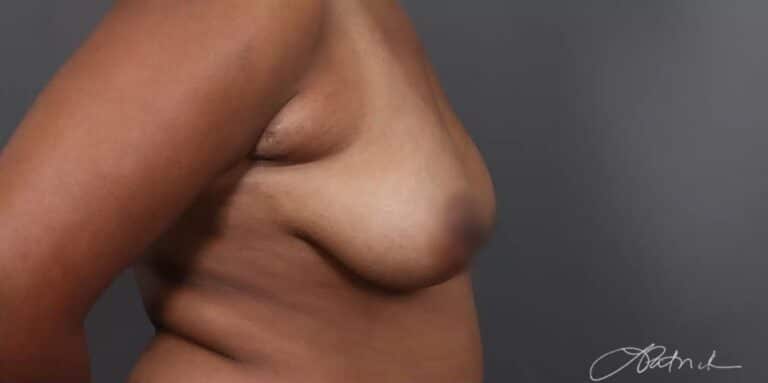 Before Image: Breast Lift with Fat Grafting - right-side