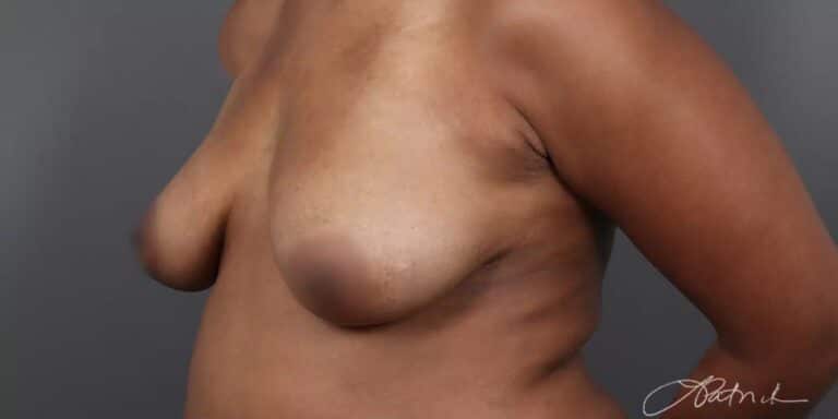 Before Image: Breast Lift with Fat Grafting - left-front-oblique
