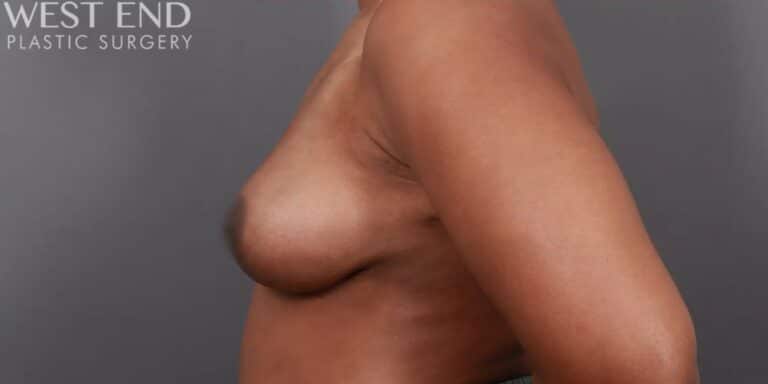 After Image: Breast Lift with Fat Grafting - left-side