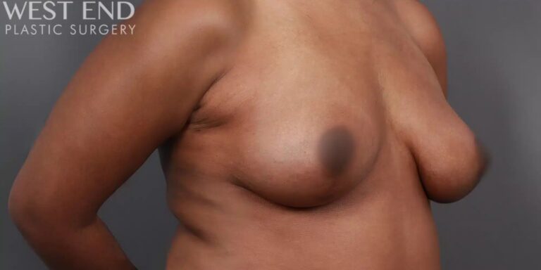 After Image: Breast Lift with Fat Grafting - right-front-oblique