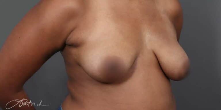 Before Image: Breast Lift with Fat Grafting - right-front-oblique