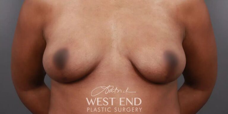 After Image: Breast Lift with Fat Grafting - front