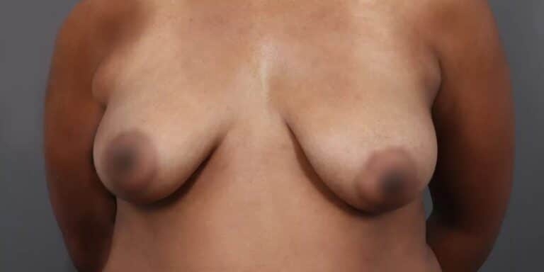 Before Image: Breast Lift with Fat Grafting - front