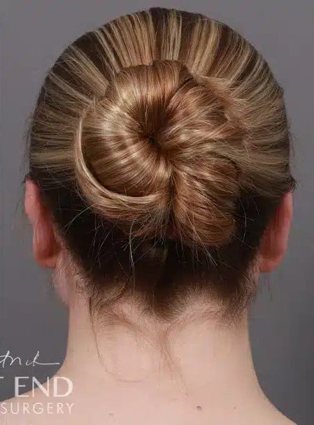 After Image: Otoplasty - back