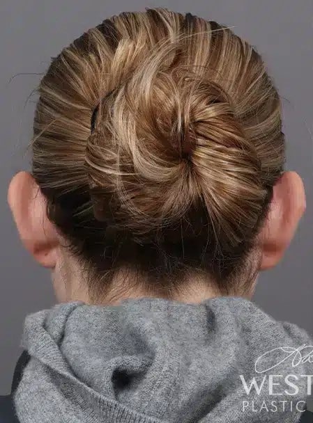 Before Image: Otoplasty - back