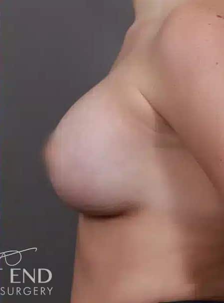 After Image: Breast Augmentation - left-side