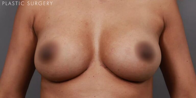 After Image: Breast Augmentation Revision & Implant Exchange - front