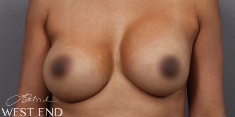 Before Image: Breast Augmentation Revision & Implant Exchange - front